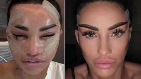 Katie Price in recovery from facelift